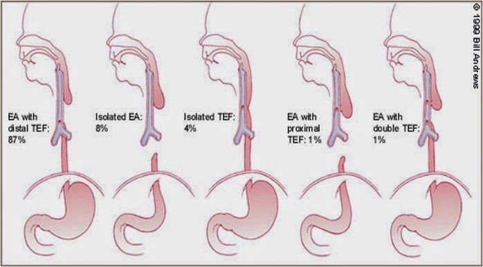 atresia esofagus adalah